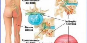Nervo ciático inflamado - causas da dor ciática - tratamento - Vico Massagista, São José SC, Quiropraxia, Massagem Terapêutica, Massoterapia e Acupuntura. Dor no piriforme
