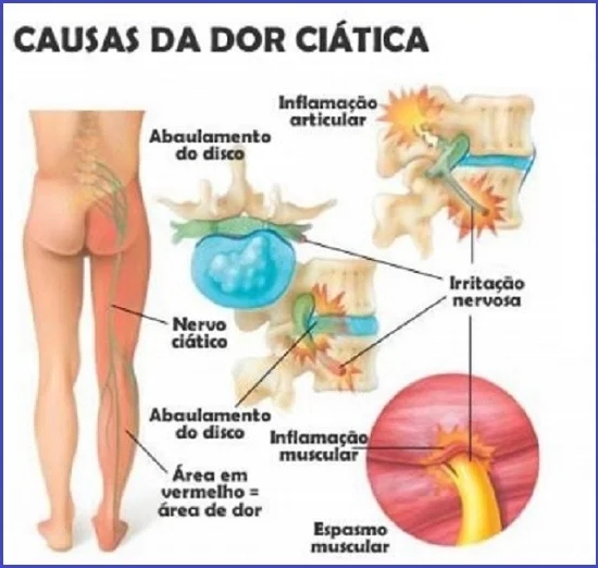 Nervo ciático inflamado - causas da dor ciática - tratamento - nervo ciático fora do lugar, mau jeito na coluna, ciatalgia, lomboaciatalgia