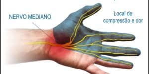 Túnel do Carpo, Síndrome - Vico Massagista e Quiropraxia - São José, Centro - Massagem Terapêutica, Massoterapia e Acupuntura