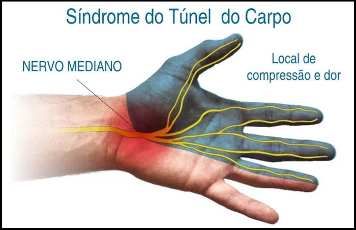 Sente dores e dormência nas mãos? Cuidado, pode ser a Síndrome do Túnel de Carpo é doença incapacitante - Túnel do Carpo, Síndrome - Vico Massagista e Quiropraxia - São José, Centro - Massagem Terapêutica, Massoterapia. #quiropraxia #massagem #ventosaterapia #saojosesc #floripa #florianopolis #palhoca #biguacu