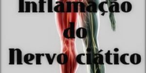 Nervo ciático inflamado - tratamento - Vico Massagista, São José SC, Quiropraxia, Massagem Terapêutica, Massoterapia e Acupuntura. Dor no piriforme