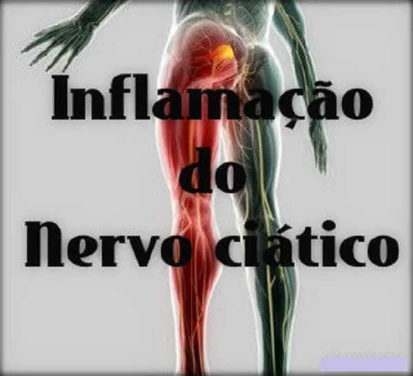 Nervo ciático como tratar a dor. inflamado. Nervo ciático fora do lugar. Lombociatalgia. Ciática. Dor que irradia ao longo do nervo ciático, que desce por uma ou ambas as pernas a partir da lombar. A causa costuma ser quando uma hérnia de disco ou um esporão na coluna pressionam o nervo. A dor tem origem na coluna e se irradia para a parte traseira da perna. 