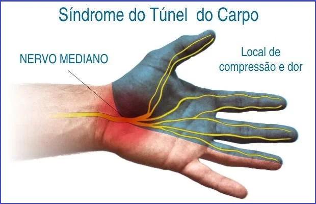 Síndrome do Túnel do Carpo: doença degenerativa causada por movimento repetitivo, dor, formigamento e dormência nas mãos - Biguaçu, Palhoça, Antonio Carlos SC, Tijucas, Santo Amaro da Imperatriz, Paulo Lopes SC, Florianópolis, São José SC - Gotas para sinusite Rinite, Jaraguá do Sul SC, Venda de Cone Chinês e Limpeza de Ouvidos, Vico Massagista Quiropraxia Acupuntura Massoterapia Massagem Relaxante Sueca Terapêutica Ventosaterapia Shiatsu Do-In Reflexologia, Síndrome do Túnel do Carpo: doença degenerativa causada por movimento repetitivo.,