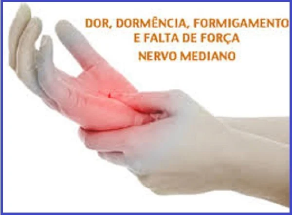 Síndrome do Túnel do Carpo: doença degenerativa causada por movimento repetitivo, dor, formigamento e dormência nas mãos Síndrome do Túnel do Carpo: doença degenerativa causada por movimento repetitivo, dor, formigamento e dormência nas mãos