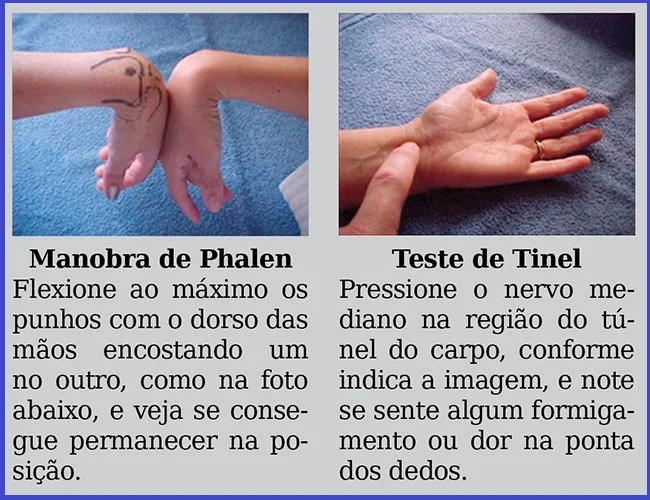 Síndrome do Túnel do Carpo: doença degenerativa causada por movimento repetitivo, dor, formigamento e dormência nas mãos Síndrome do Túnel do Carpo: doença degenerativa causada por movimento repetitivo, dor, formigamento e dormência nas mãos
