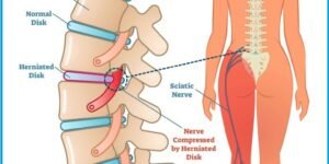 Este nervo se origina no plexo lombo sacro, ou seja, na região lombar. E é formado por diversas ramificações que se ligam às últimas vértebras e à base da coluna vertebral e atravessam o quadril, os glúteos, a coxa, o joelho e o tornozelo. Quando chega na metade do fêmur, o maior osso da coxa, o ciático se divide em fibular e tibial, que são ramificações que seguem pela perna.