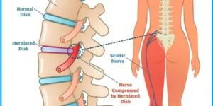 Este nervo se origina no plexo lombo sacro, ou seja, na região lombar. E é formado por diversas ramificações que se ligam às últimas vértebras e à base da coluna vertebral e atravessam o quadril, os glúteos, a coxa, o joelho e o tornozelo. Quando chega na metade do fêmur, o maior osso da coxa, o ciático se divide em fibular e tibial, que são ramificações que seguem pela perna.
