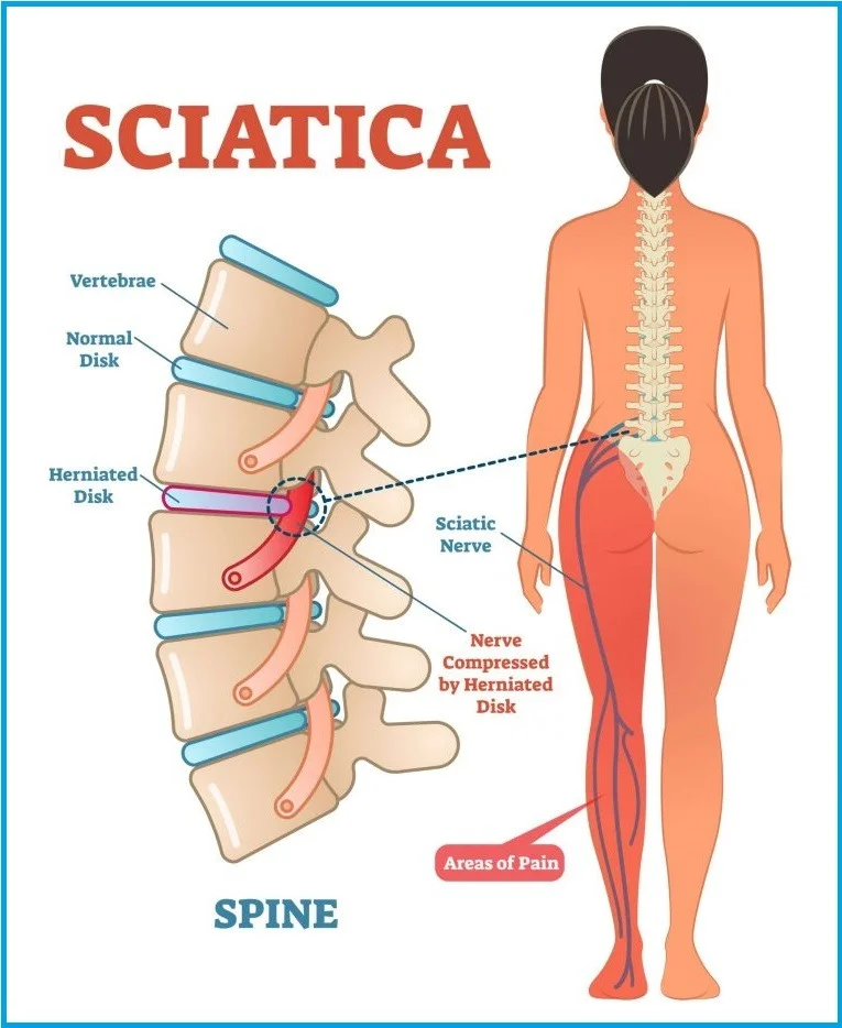 Onde fica o nervo ciático no corpo humano? #nervociatico #vicomassagista #quiropraxia #saojosesc #florianopolis Onde fica o nervo ciático no corpo humano? Este nervo se origina no plexo lombo sacro, ou seja, na região lombar. E é formado por diversas ramificações que se ligam às últimas vértebras e à base da coluna vertebral e atravessam o quadril, os glúteos, a coxa, o joelho e o tornozelo. Quando chega na metade do fêmur, o maior osso da coxa, o ciático se divide em fibular e tibial, que são ramificações que seguem pela perna.