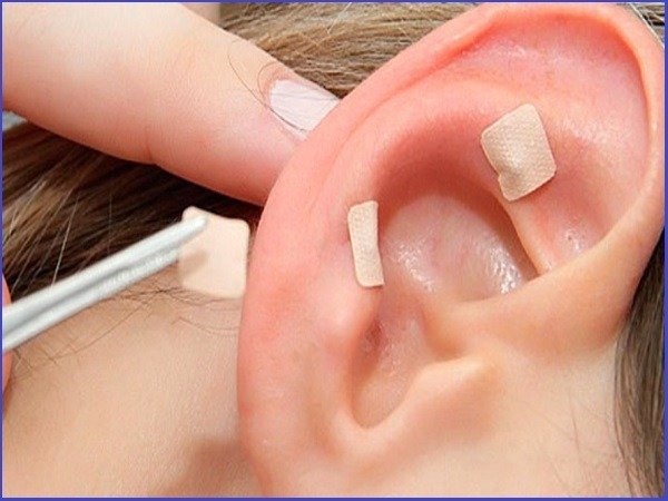Auriculoterapia, Acupuntura Auricular, Auriculopuntura - Vico Massagista, São José SC - O que você precisa saber sobre Auriculoterapia, benefícios, indicações. microagulhas,semente