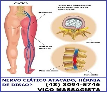 Quiropraxia para nervo ciático com o terapeuta Vico Massagista e Quiropraxia em São José (SC)