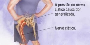 Dor no nervo ciático - Massagem - Centro, São José SC