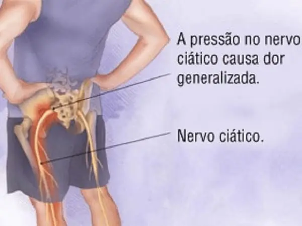 Nervo ciático - Massagem para dor no nervo ciático - Vico Massagista e Quiropraxia
