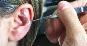 Acupuntura Auricular (Auriculoterapia) com Vico Massagista e Quiropraxia. Terapeuta profissional e experiente com mais de 30 anos de experiência na área da saúde. Especialista em Auriculoterapia (acupuntura Auricular).